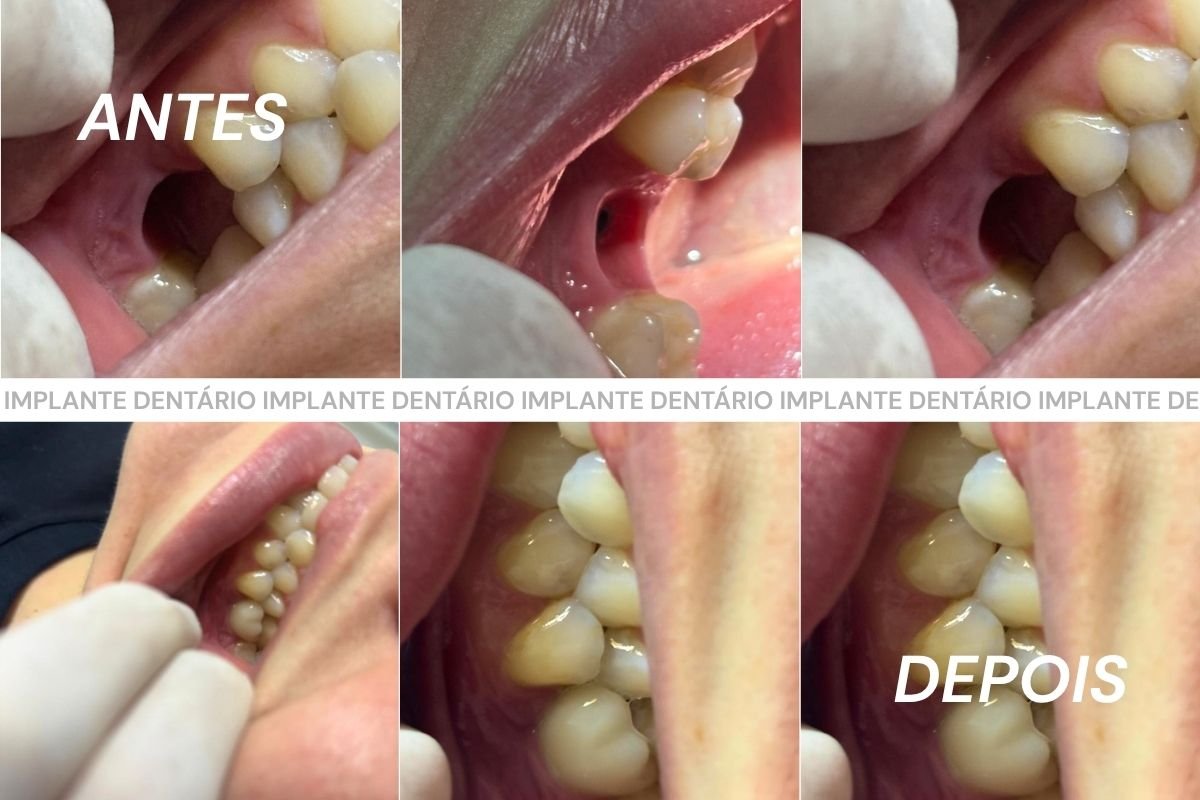 Especialista em implante dentário realizando atendimento em São Carlos.