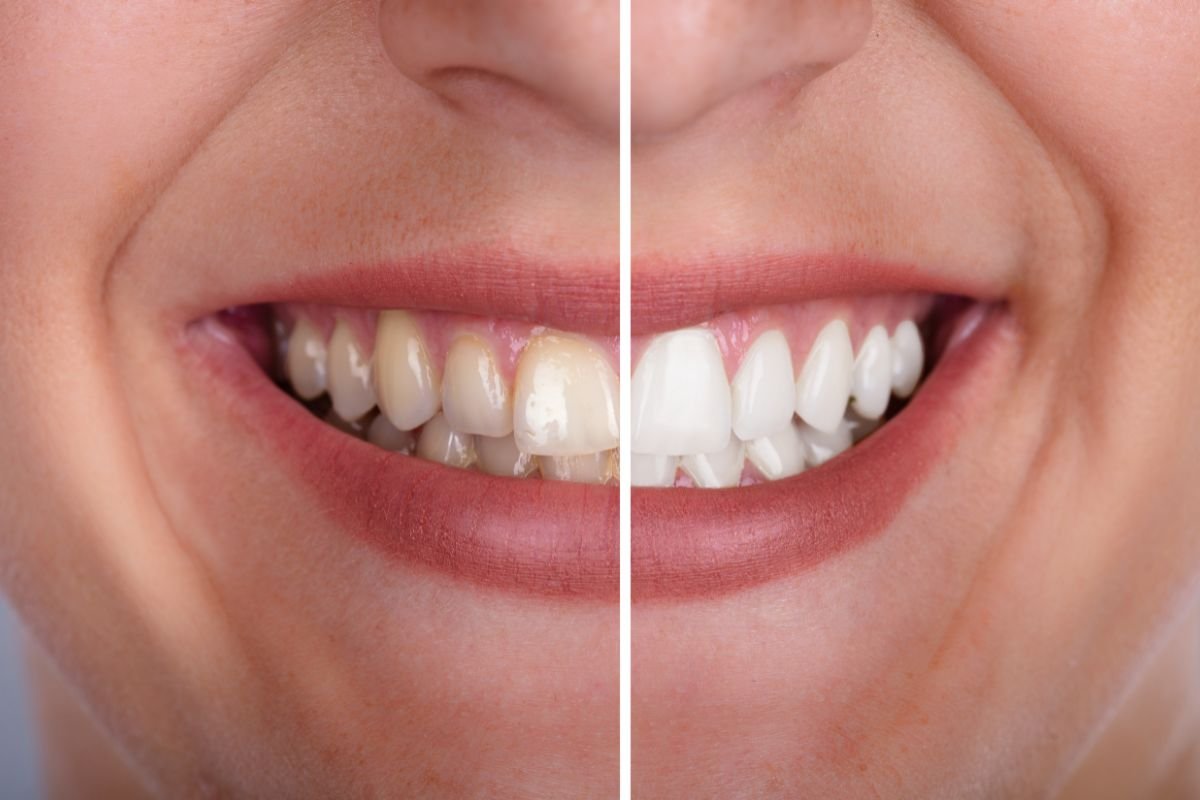 Resultado do clareamento dental realizado na Moari Odontologia
