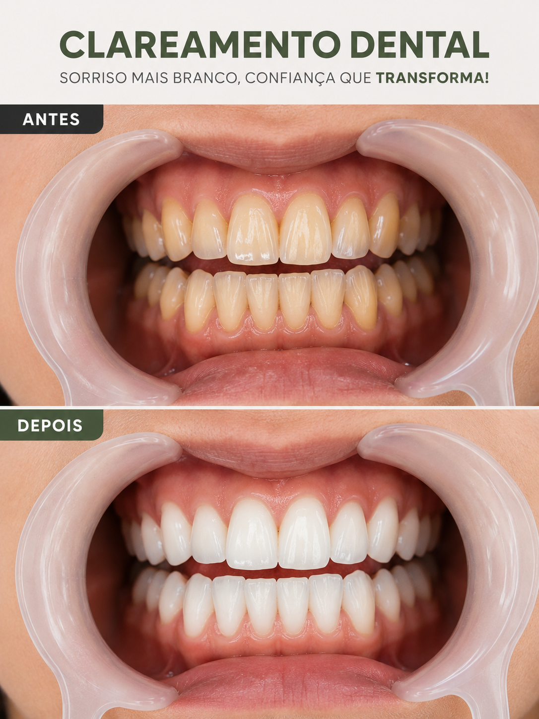 Resultado do clareamento dental realizado na Moari Odontologia