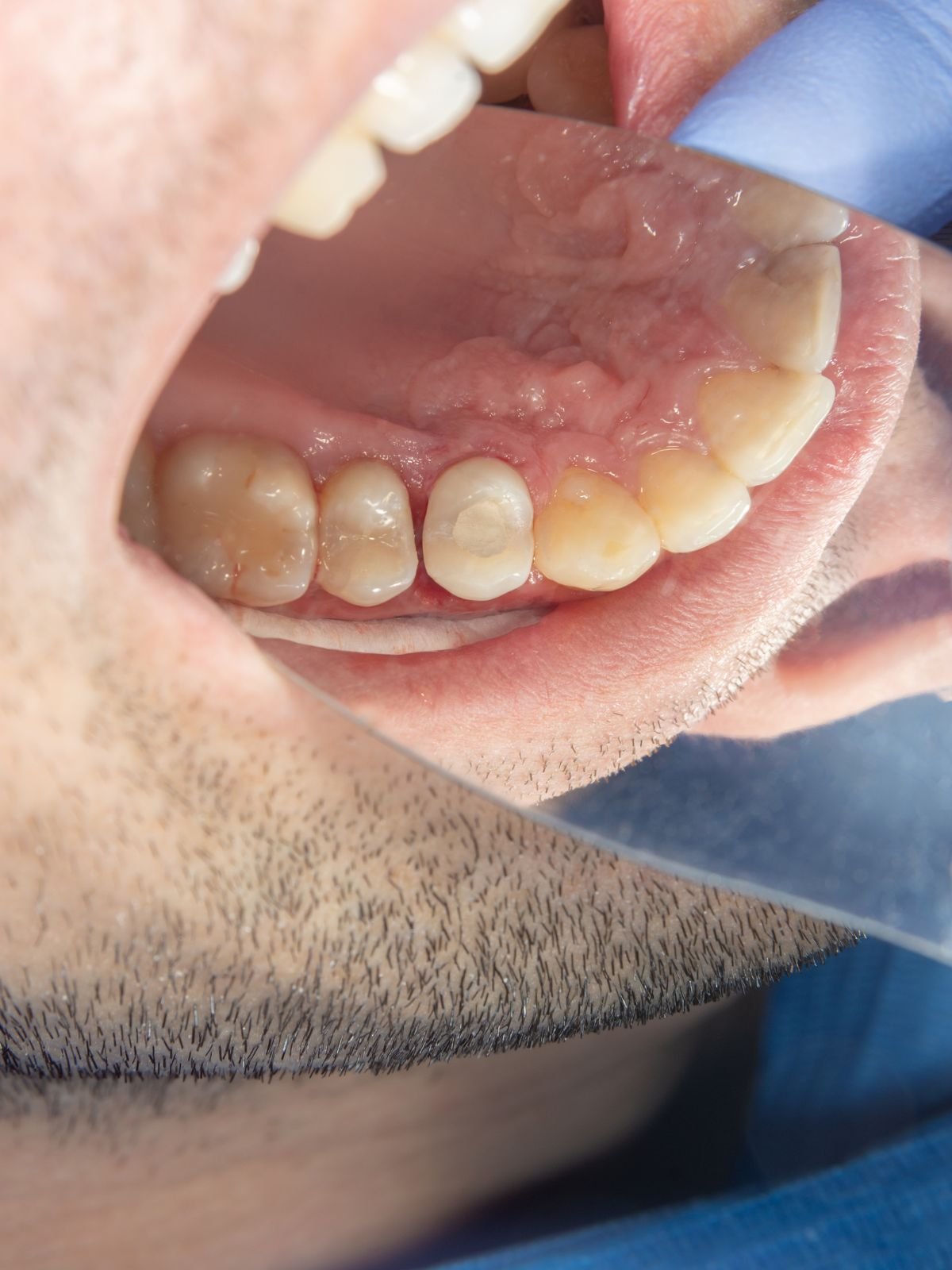 Paciente realizando tratamento de canal na Moari Odontologia em São Carlos