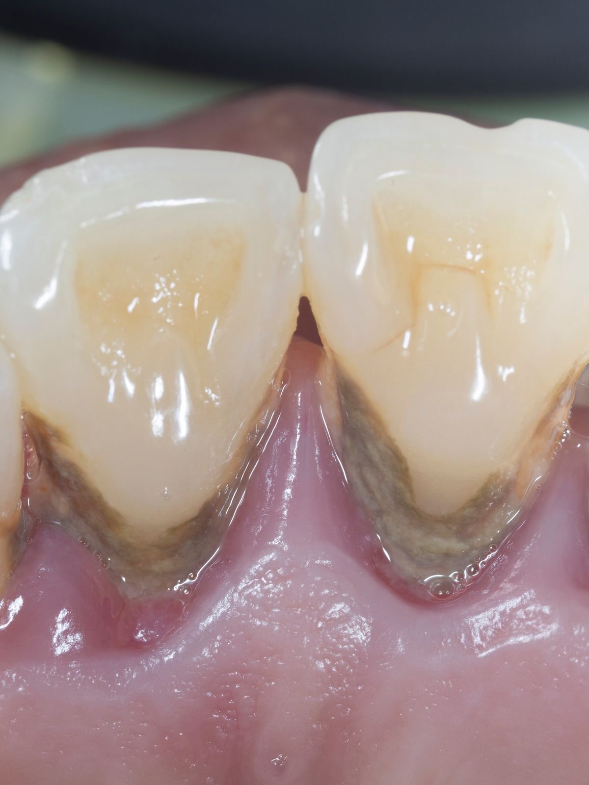 Tratamento da gengivite realizado na Moari Odontologia